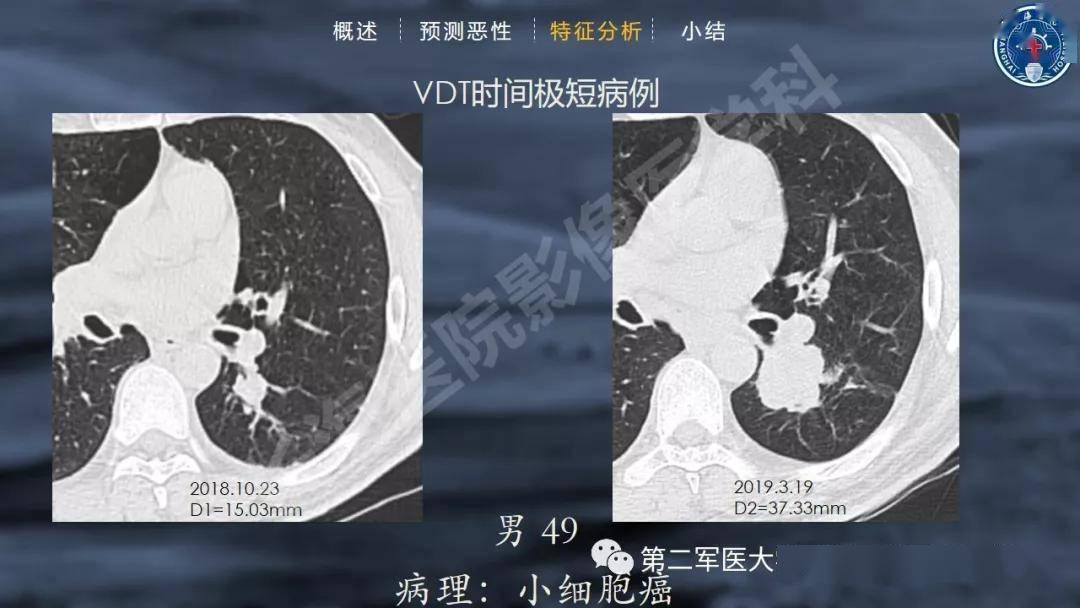 实性肺结节的良恶性ct征象解析