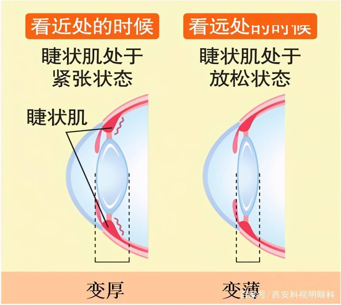 睫状肌位于前部巩膜内面和脉络膜上腔内的睫状体肌肉纤维束,是睫状体