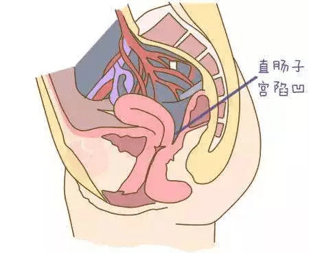 "盆腔积液"不是病?_症状
