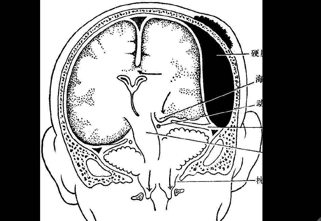 高清解剖:脑室/脑池/脑膜