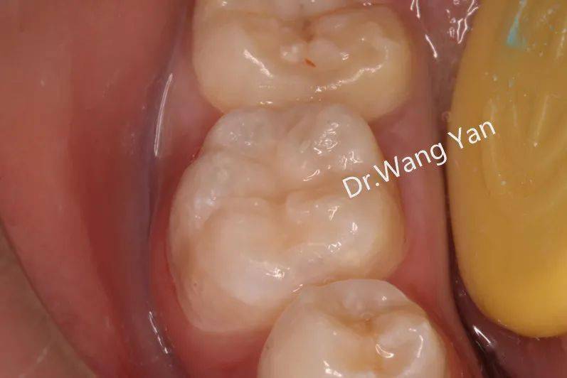 松风病例秀王艳小技术大美学年轻恒牙印章法树脂充填