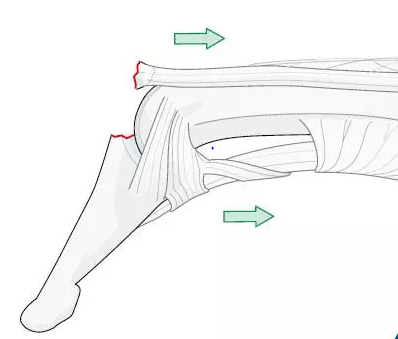 锤状指,又称为棒球指,是指手指的伸肌腱止点处断裂,末节下垂,不能