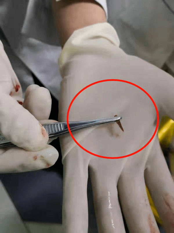 手外科医师给患者做了手部清创,在伤口内发现了"罪魁祸首":1个长约1
