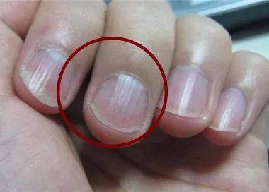 警惕:指甲上的小竖纹,可能是体内器官病变的求救信号!