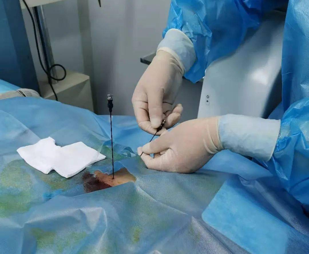 射频消融术5——不开刀治疗"难缠"腰椎间盘突出症