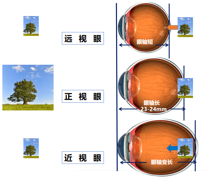 眼轴变化情况