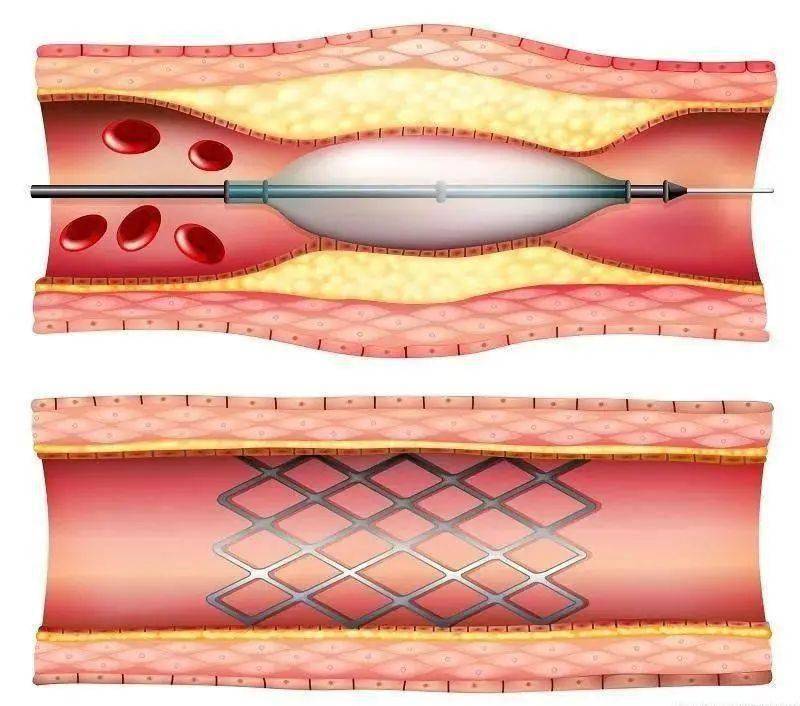 血管腔内治疗是否一定 要"安装支架"呢?