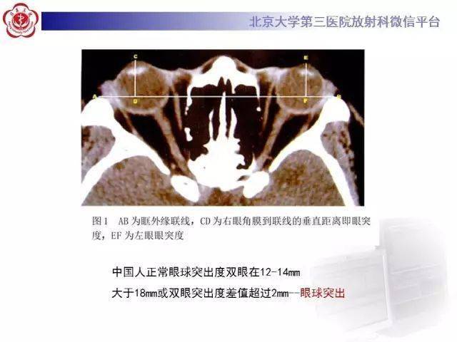 特发性眼眶炎性假瘤影像表现