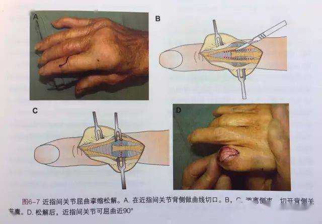 手指关节卡住不能动,是怎么回事?