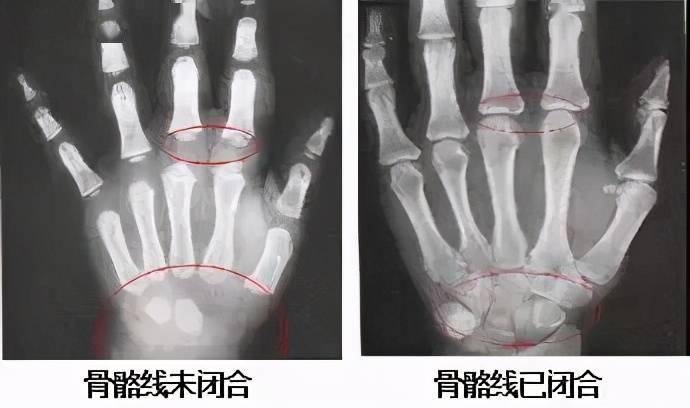 而骨龄检查就是拍摄手腕部的x光片,观察左手(一般拍左手,少数拍右手)