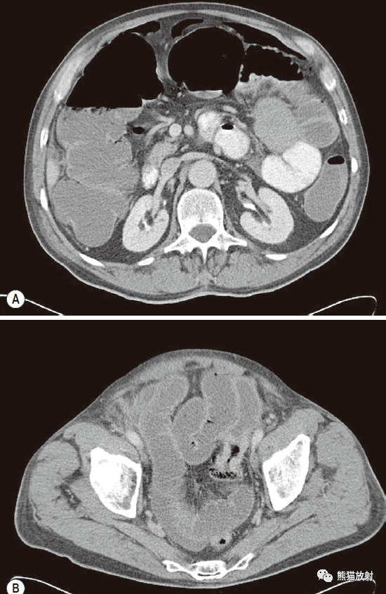 大肠梗阻.乙状结肠腺癌致管腔狭窄,上游结肠扩张,多发气液平面.