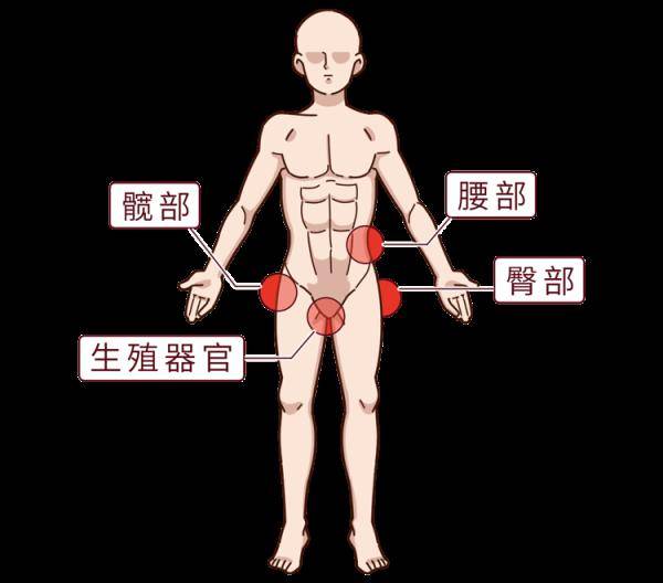 腹股沟,骼内外等部位表现为体表淋巴结,下肢肿大骨转移后期还可能发生