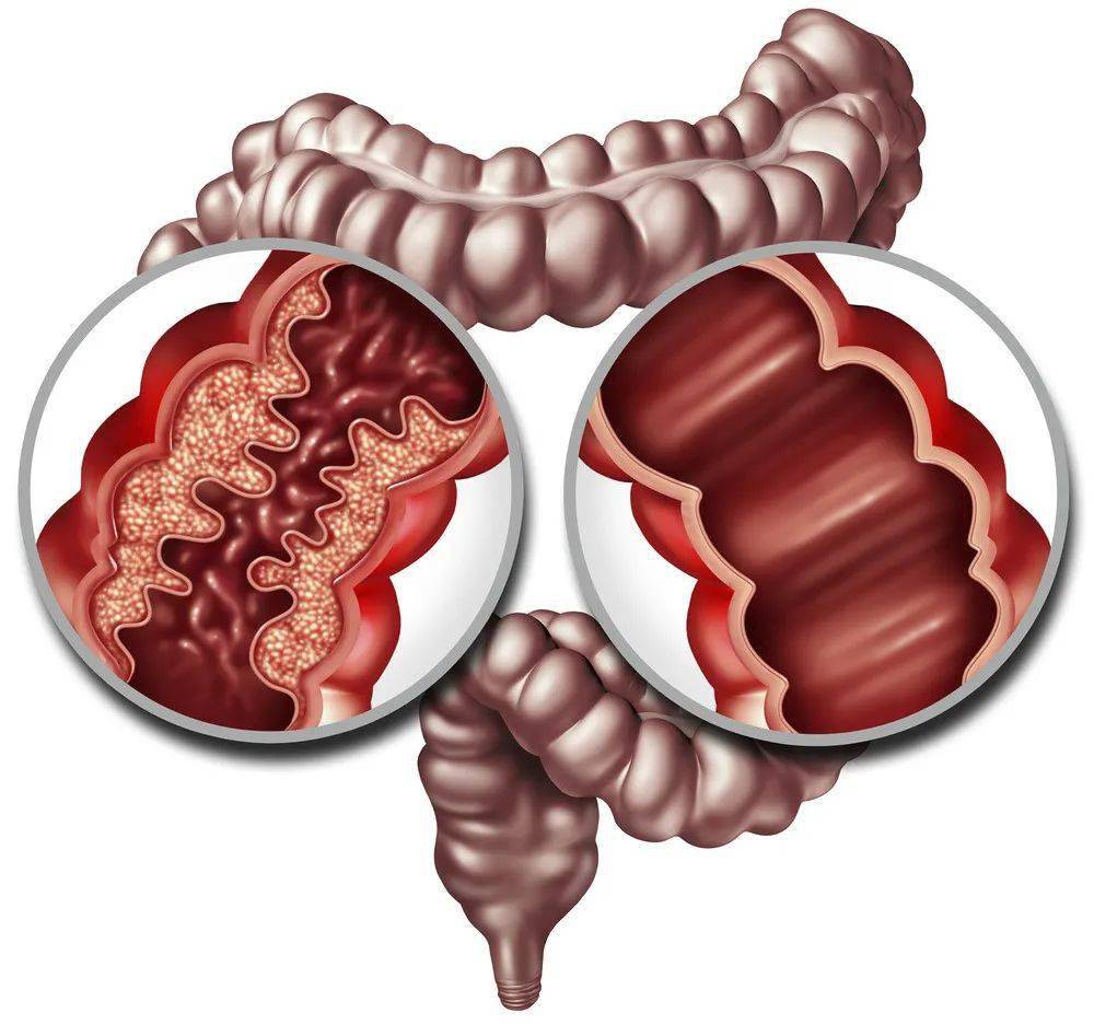 克罗恩病和健康肠道图解大肠恶变当大便中常混有粘液,血液或脓液,大便