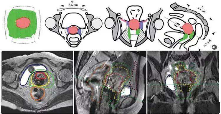 用三维技术精准治疗宫颈癌!_放疗