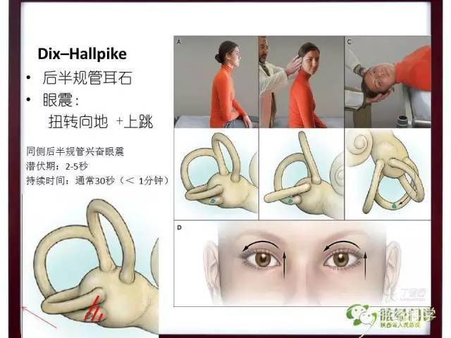 图 roll test示意图cba图 roll test该检查法是判断外半规管耳石症的