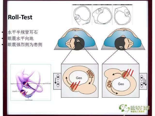 手把手教你诊治良性阵发性位置性眩晕含最全的耳石症复位方法