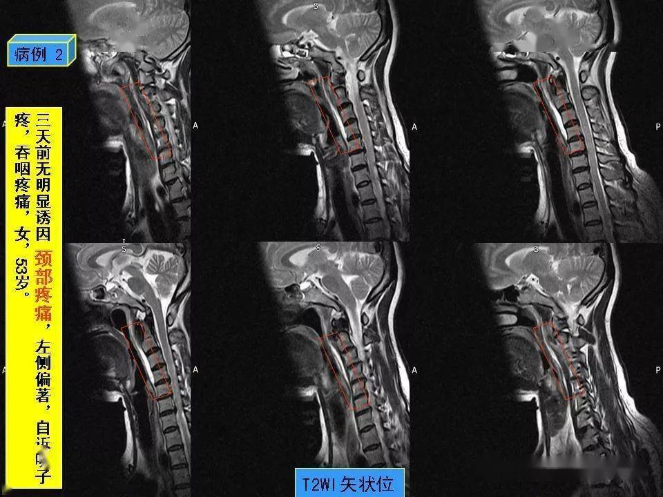 颈椎mri椎体前缘的条状高信号影,终于知道是什么啦