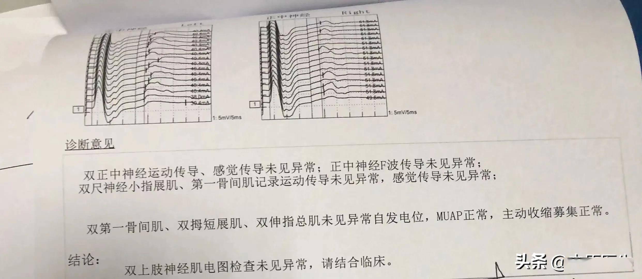 我安排了科室人员给患者行肌电图检查,结果是正常的.