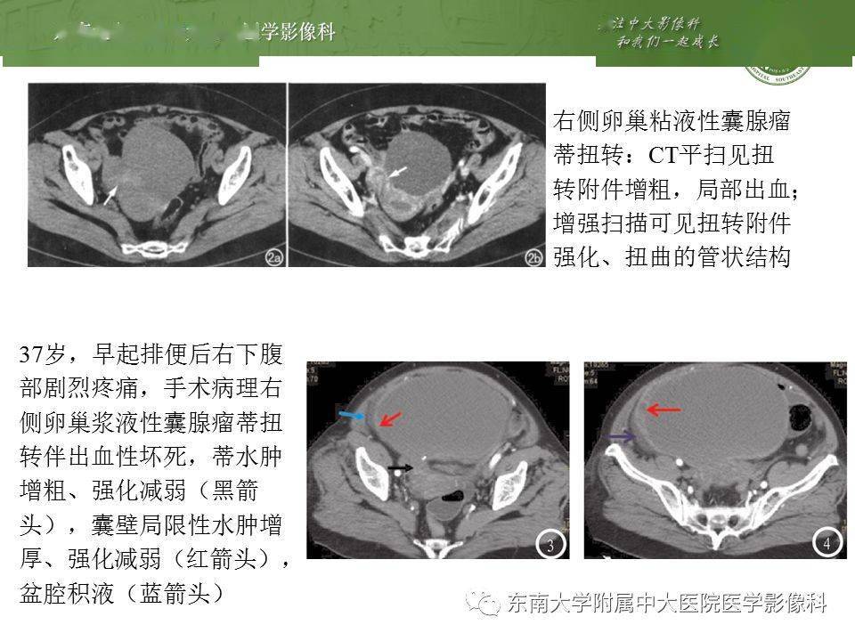 卵巢囊肿蒂扭转影像表现