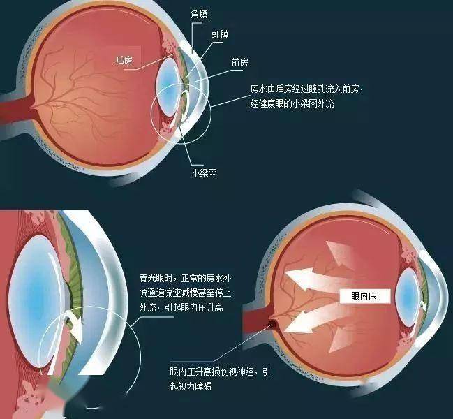 主要分为原发性青光眼,继发性青光眼,先天性青光眼和混合性青光眼