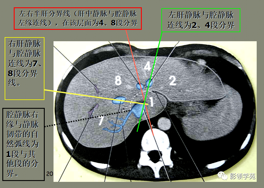 最全总结 肝脏的表面解剖及分叶分段,太赞了_门静脉