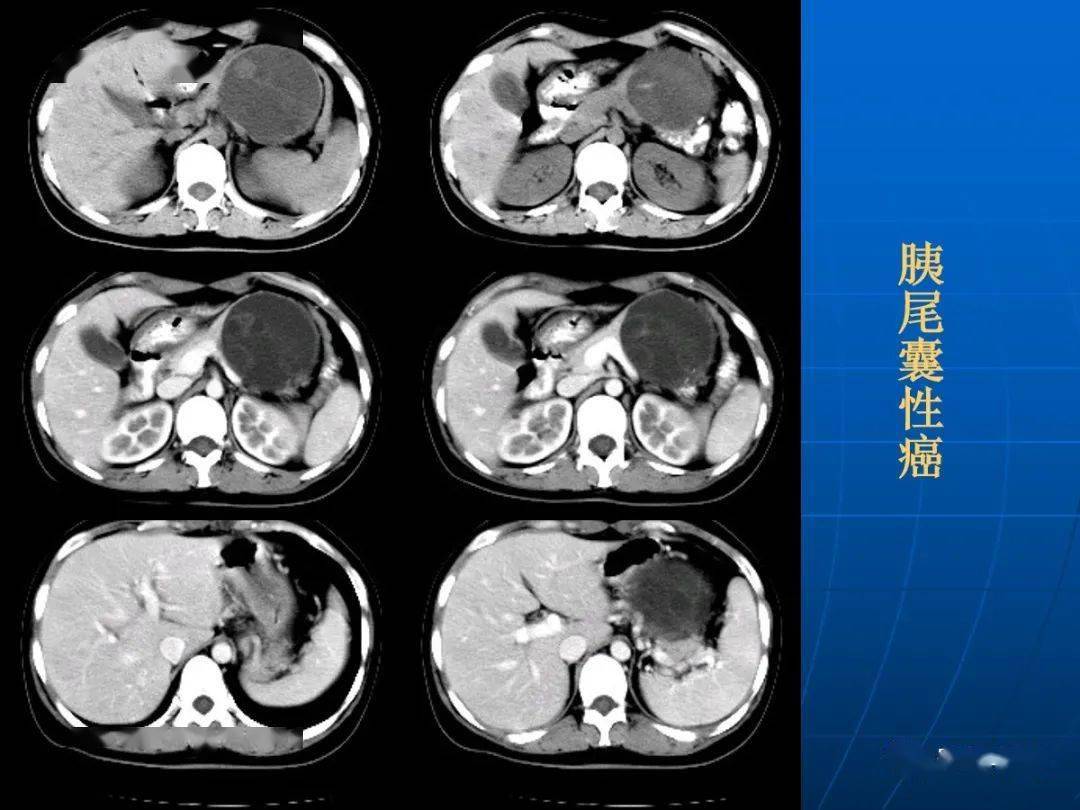 9种胰腺常见疾病的ct诊断