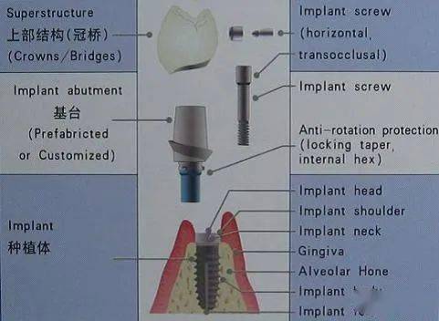 假牙大全总有款假牙适合您