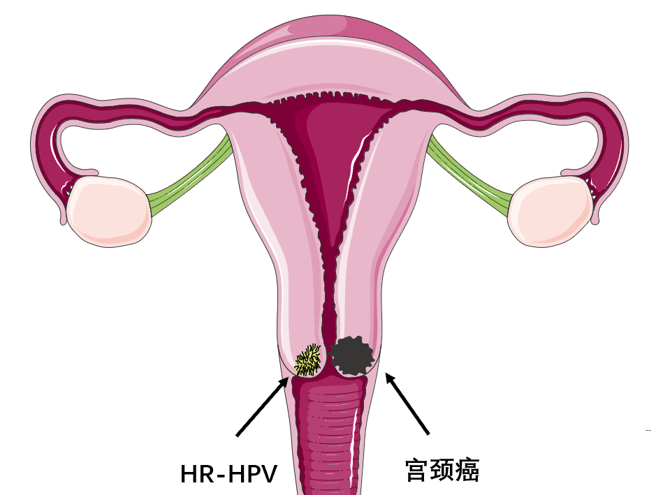 宫颈癌与肿瘤标志物高风险人乳头状瘤病毒hrhpv篇