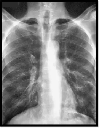 短暂或固定的肺部浸润. 中央支气管扩张. 外周血嗜酸性粒细胞增多症.