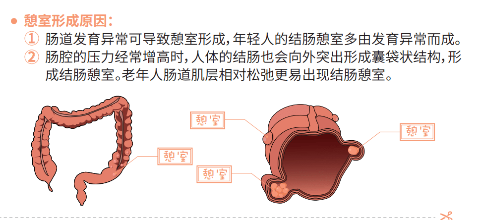 结肠憩室是什么,怎么形成的?北 平 说那么"结肠憩室"到底是什么呢?