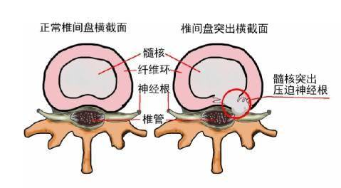 专家支招:腰间盘突出治疗如何少走弯路_小张