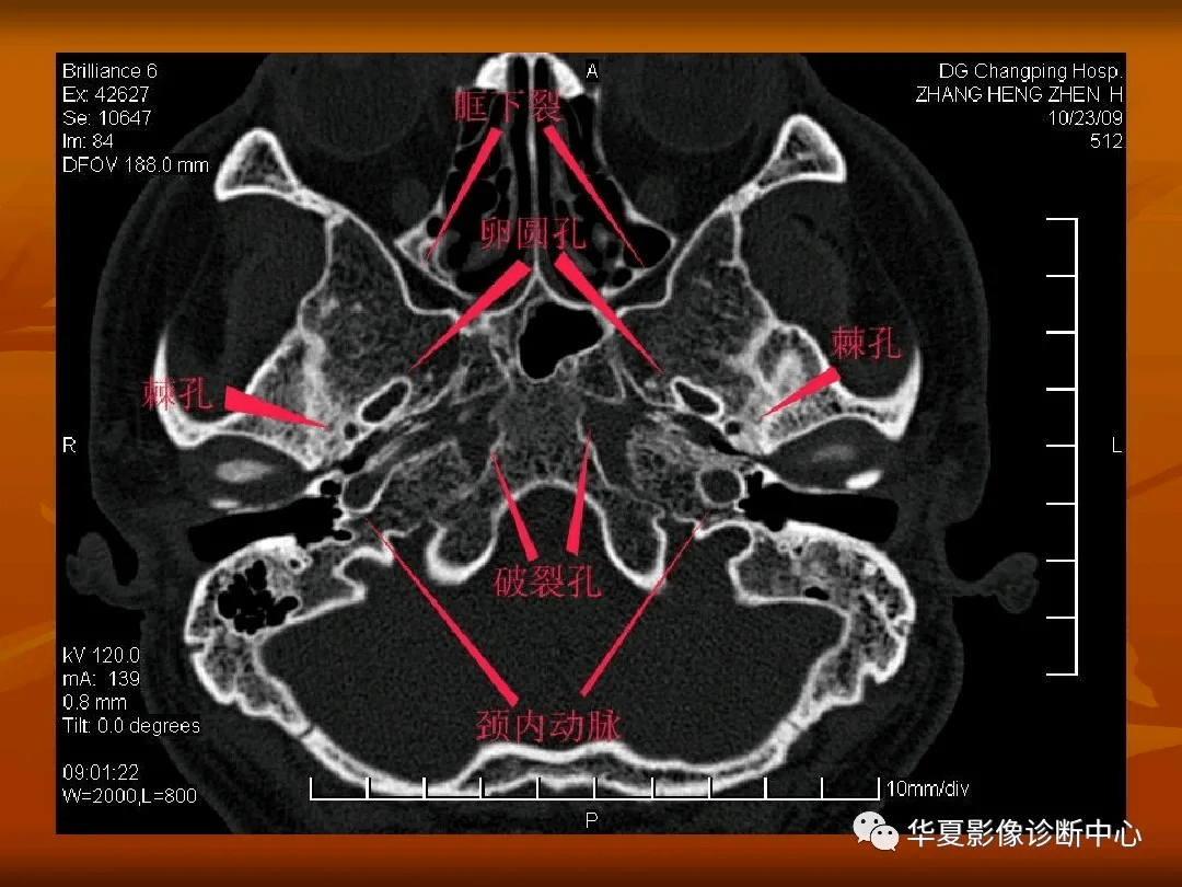 颅底ct高清图解 常见骨折部位图示