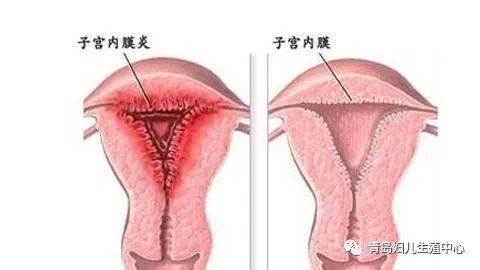 慢性子宫内膜炎对胚胎着床的影响