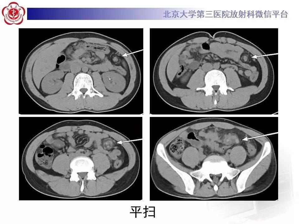 副脾蒂扭转少见部位副脾影像表现