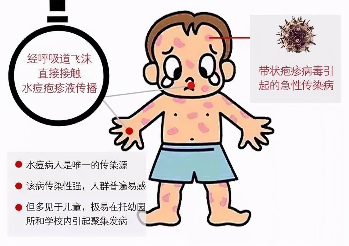 孟津二院门诊儿科小课堂丨春季常见传染病之一水痘