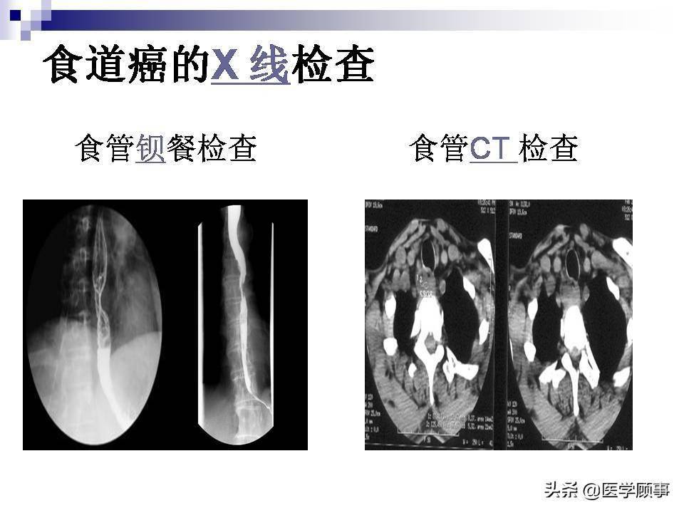 食道癌科普及影像分析