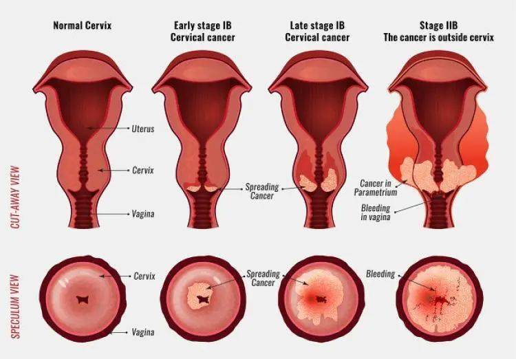 (宫颈癌过程图)