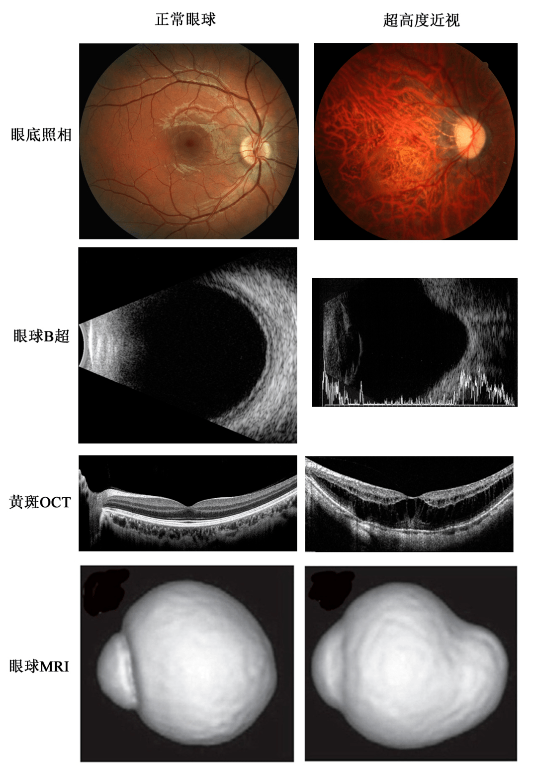 玻璃体液化,混浊 视网膜脉络膜病变 视网膜脱离 后巩膜葡萄肿 青光眼