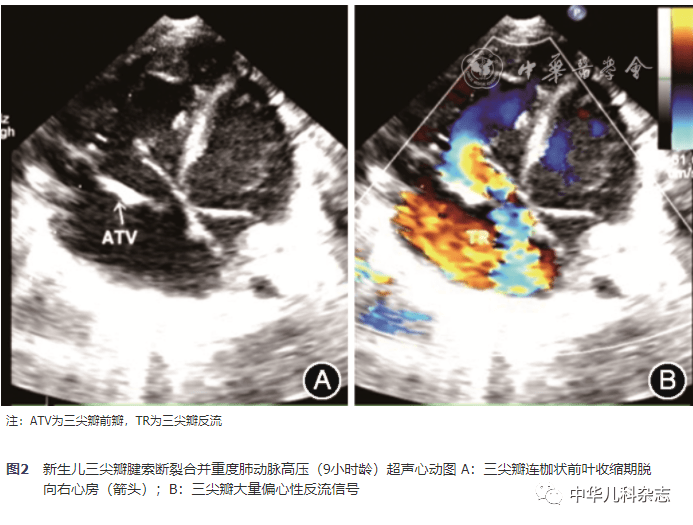 新生儿疾病研究新生儿三尖瓣腱索断裂合并重度肺动脉高压一例并文献