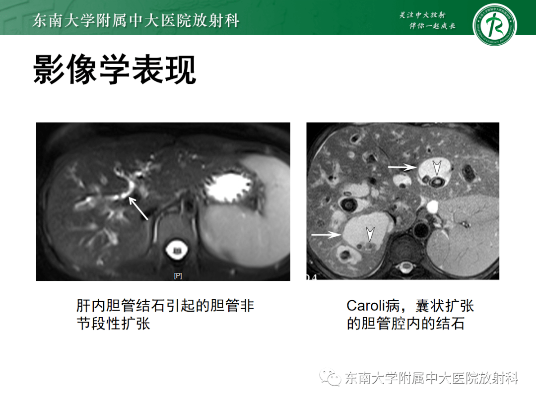 caroli病鉴别诊断