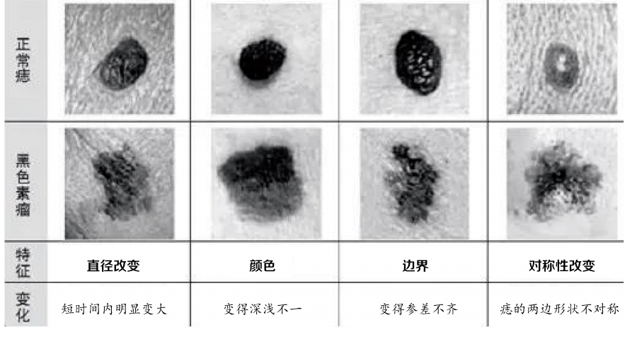 根据黑色素细胞来源不同,我们又可以将痣分成不同类型,其中最常见的