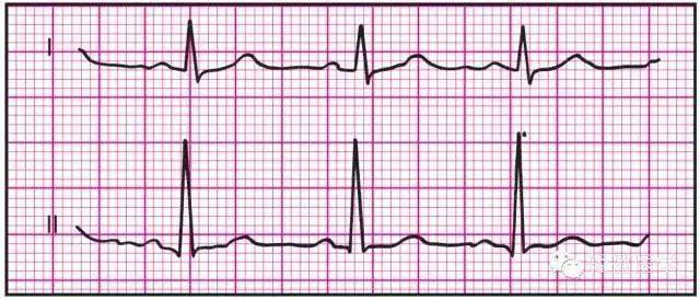 最全面的异常心电参考图,建议收藏!