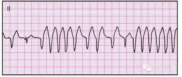 最全面的异常心电参考图,建议收藏!