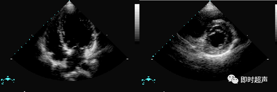 心脏瓣膜病超声诊断_二尖瓣