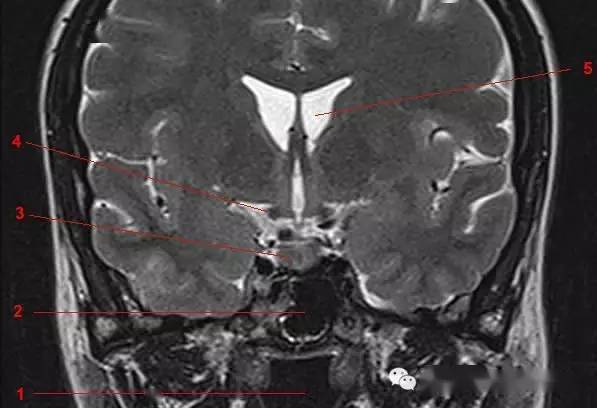 鞍区,垂体磁共振(mri)解剖——冠状面