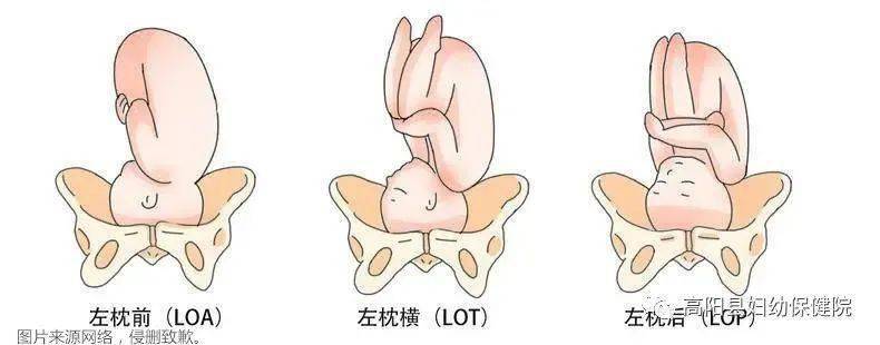 其中,只有枕先露是正常胎位,再根据宝宝头部与妈妈骨盆的关系又分为左