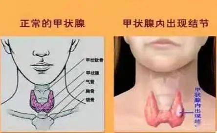 淄博市妇幼保健院:理性看待甲状腺结节