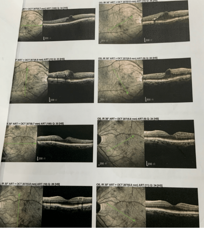 6) 治疗前oct显示黄斑囊样水肿,累及黄斑中心凹,结合患者糖尿病病史