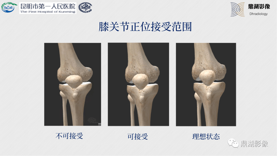 如何拍出完美的膝关节x线片这些经验太重要了