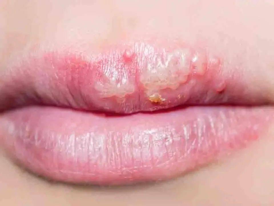 一般情况下,口唇疱疹在2周左右就会愈合,仅有极少部分人出现疱疹性